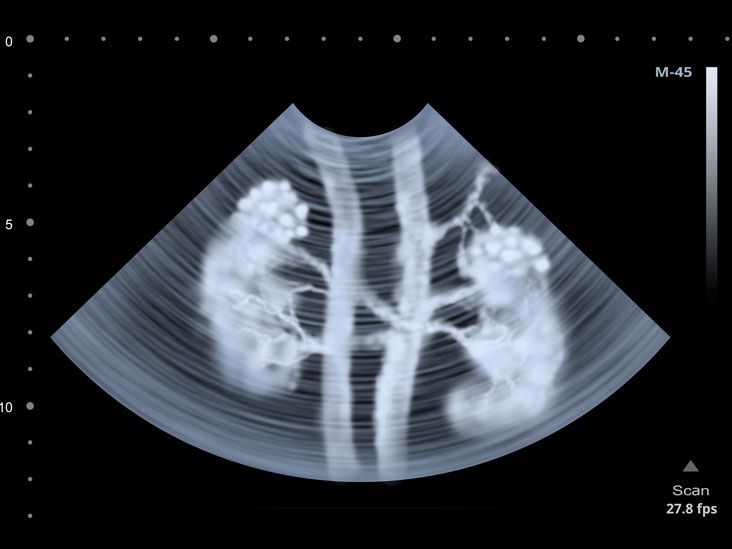 Renal Scan (DTPA / EC / MAG3)