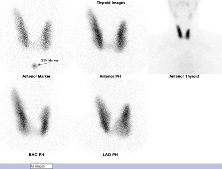 Thyroid Scan & Uptake